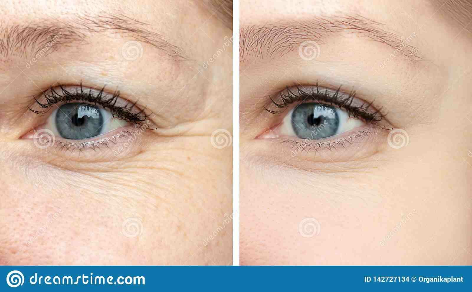 Comment enlever les rides sur le visage ?